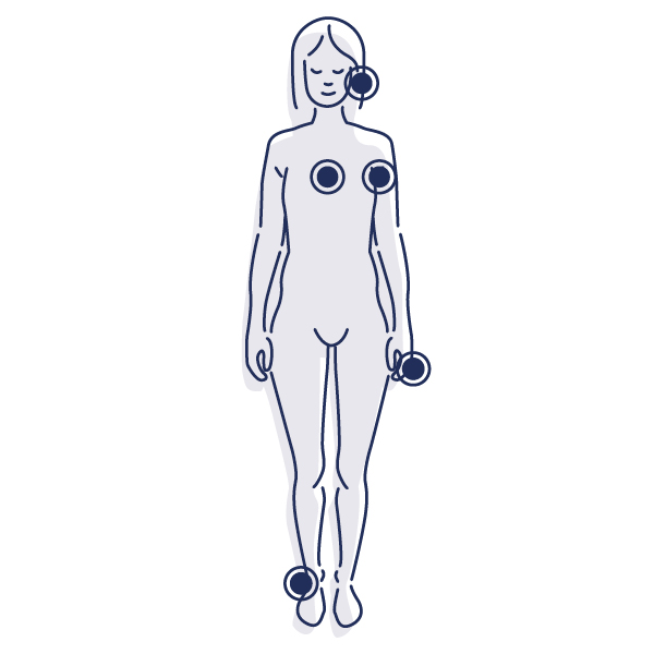 Grafik der Prävalenzstellen der lokalisierten Hyperhidrose