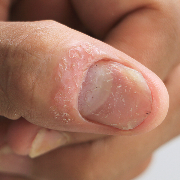 Eine Form der Nagelpsoriasis am Finger
