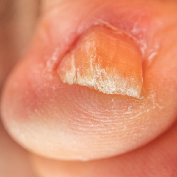 Eine Form von Nagelpsoriasis an einem Zeh