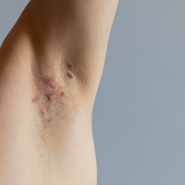 Acne inversa in der Achselhöhle