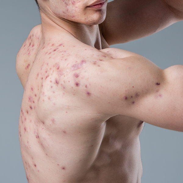 Doping Akne auf dem Rücken eines jungen Mannes