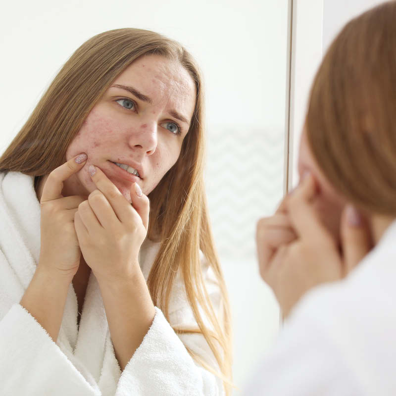 Eine Frau betrachtet ihre Acne tarda auf der Wange