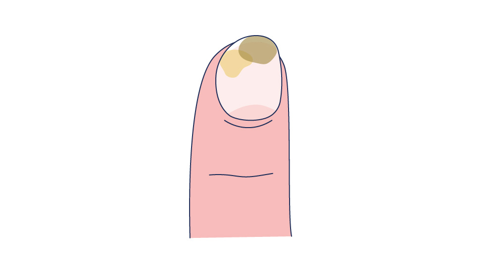 Illustration eines Nagels mit Ölflecken