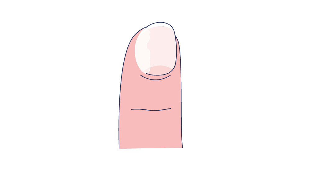 Illustration einer Onycholyse mit der Ablösung des Nagelbettes