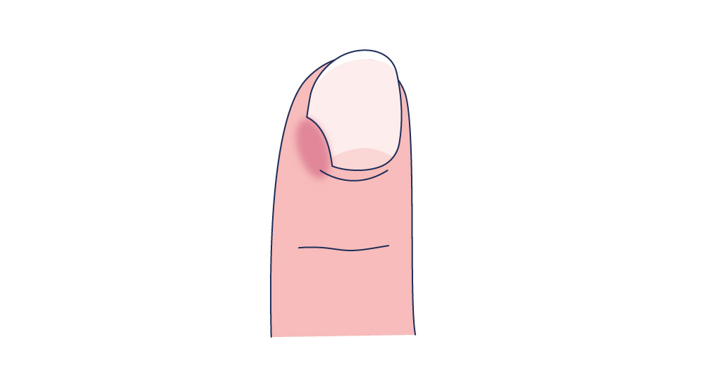 Illustration eines Nagels mit Schwellungen der Nagelfalz