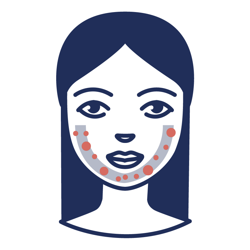 Grafik zu Akne in der U-Zone