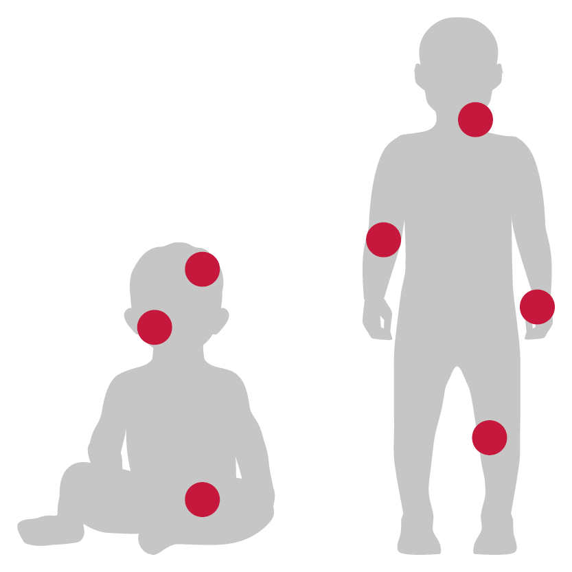 Prädilektionsstellen von Neurodermitis bei Babys und Kindern
