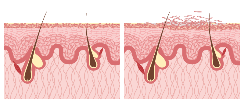 Grafik zu Schuppen auf Kopfhaut