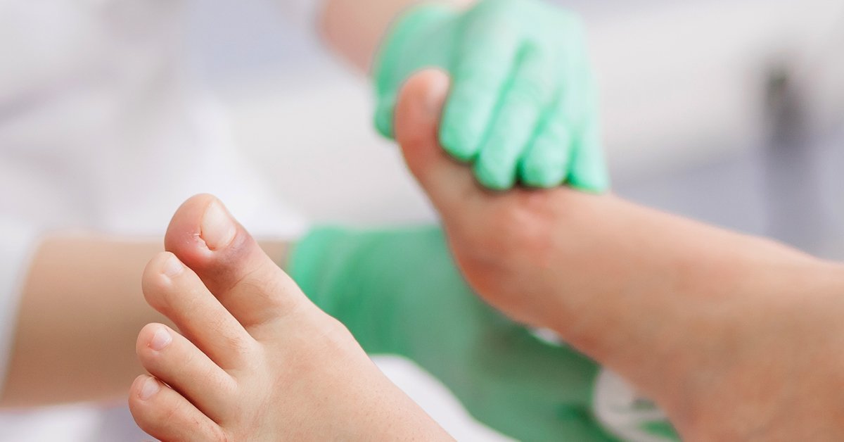 Diabetisches Fußsyndrom – Ursachen und Pflegetipps