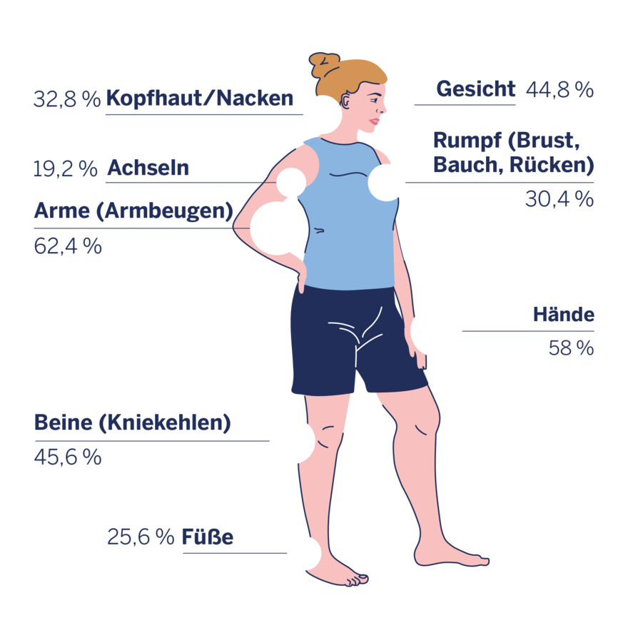Infografik zu den von Neurodermitis betroffenen Körperstellen bei Frauen.