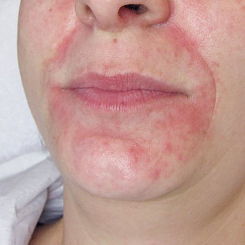 Beispielbild von Perioraler Dermatitis