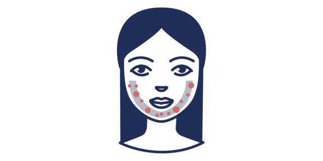 Illustration der Acne tarda in der U-Zone