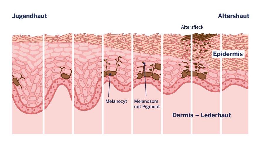 Infografik: Entstehung von Altersflecken