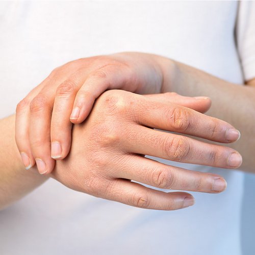 Hände mit Fischschuppenkrankheit