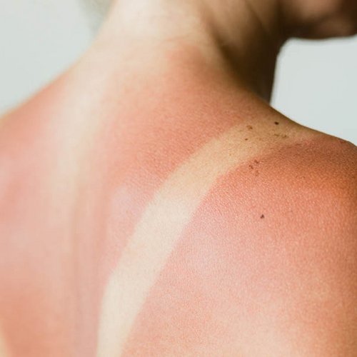 Durch einen Sonnenbrand gerötete Schulter