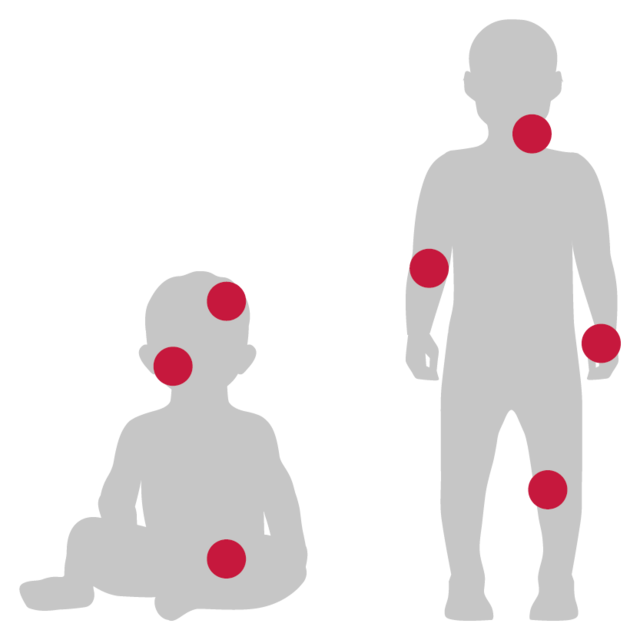 Prädilektionsstellen von Neurodermitis bei Babys und Kindern