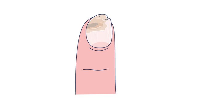 Illustration eines verdickten, brüchigen Krümelnagels