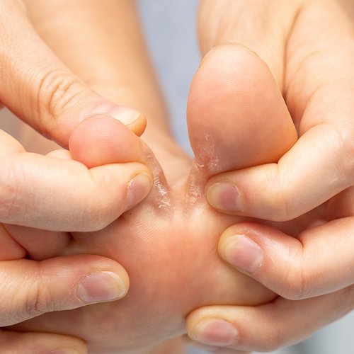 Bild von einem Fuß mit Fußpilz