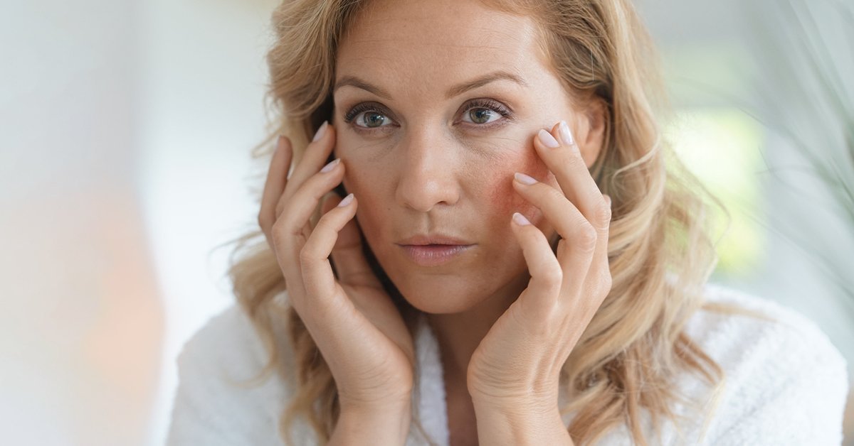 Hilfe bei Couperose Rote Äderchen im Gesicht behandeln