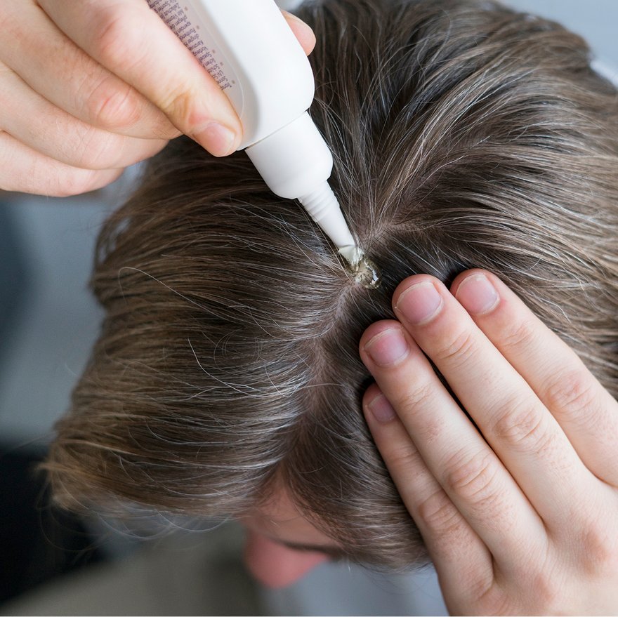 Mann trägt Kopfhautpflege auf 