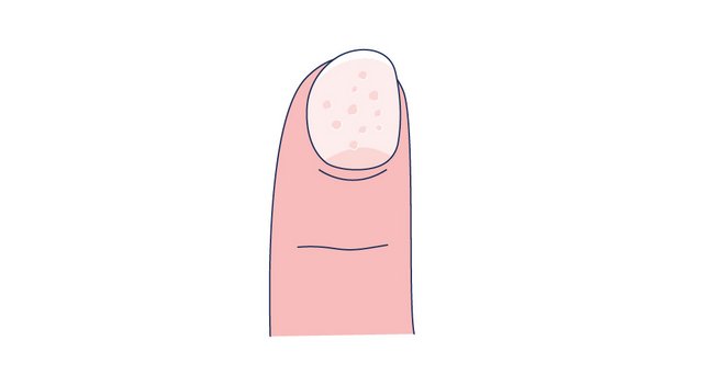 Illustration eines Tüpfelnagels mit punktförmigen Einsenkungen im Nagel