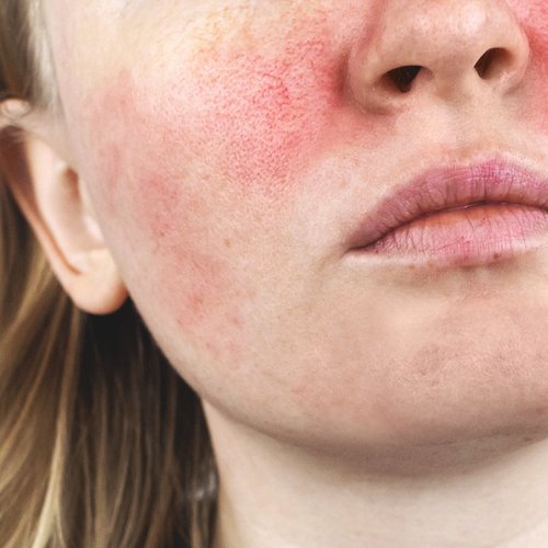 Ein von Rosacea geprägtes Gesicht.