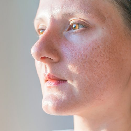 Frau mit großen Talgdrüsen bzw. Poren