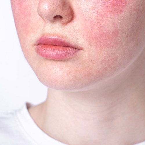 Untere Gesichtspartie einer Frau mit Rosacea auf den Wangen