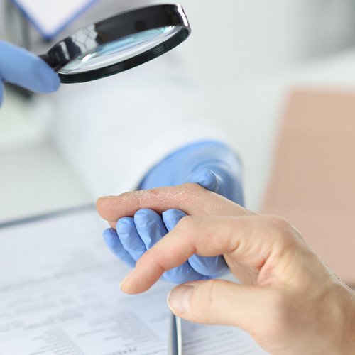 Arzt untersucht Nagelpsoriasis seines Patienten