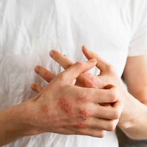 Mann, der Ekzeme an der Hand hat und sich kratzt