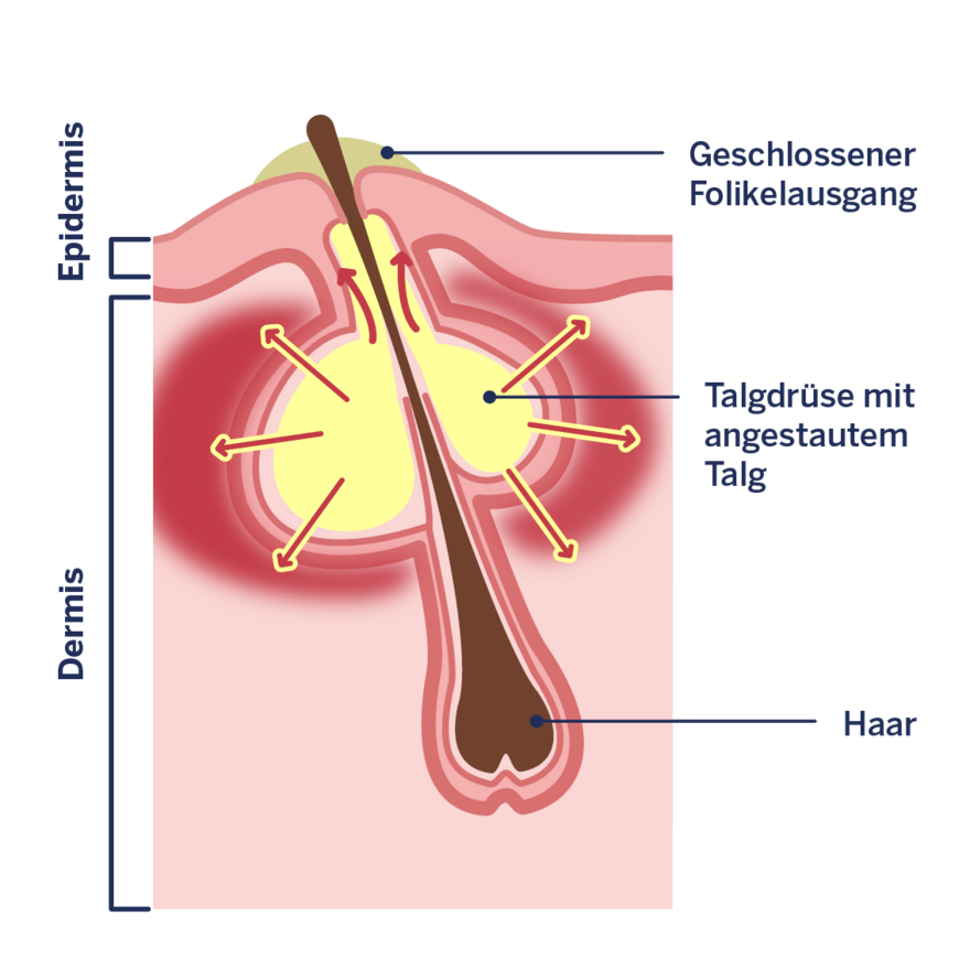 Infografik: Entstehung unreiner Haut