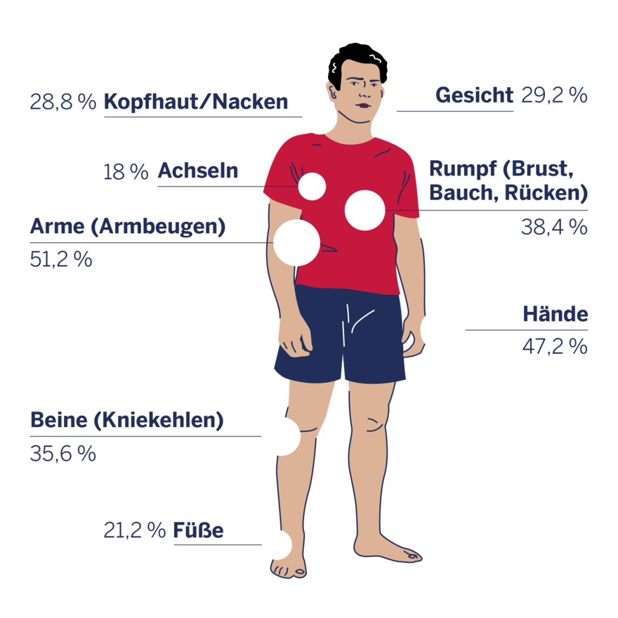 Infografik zu den von Neurodermitis betroffenen Körperstellen bei Männern.