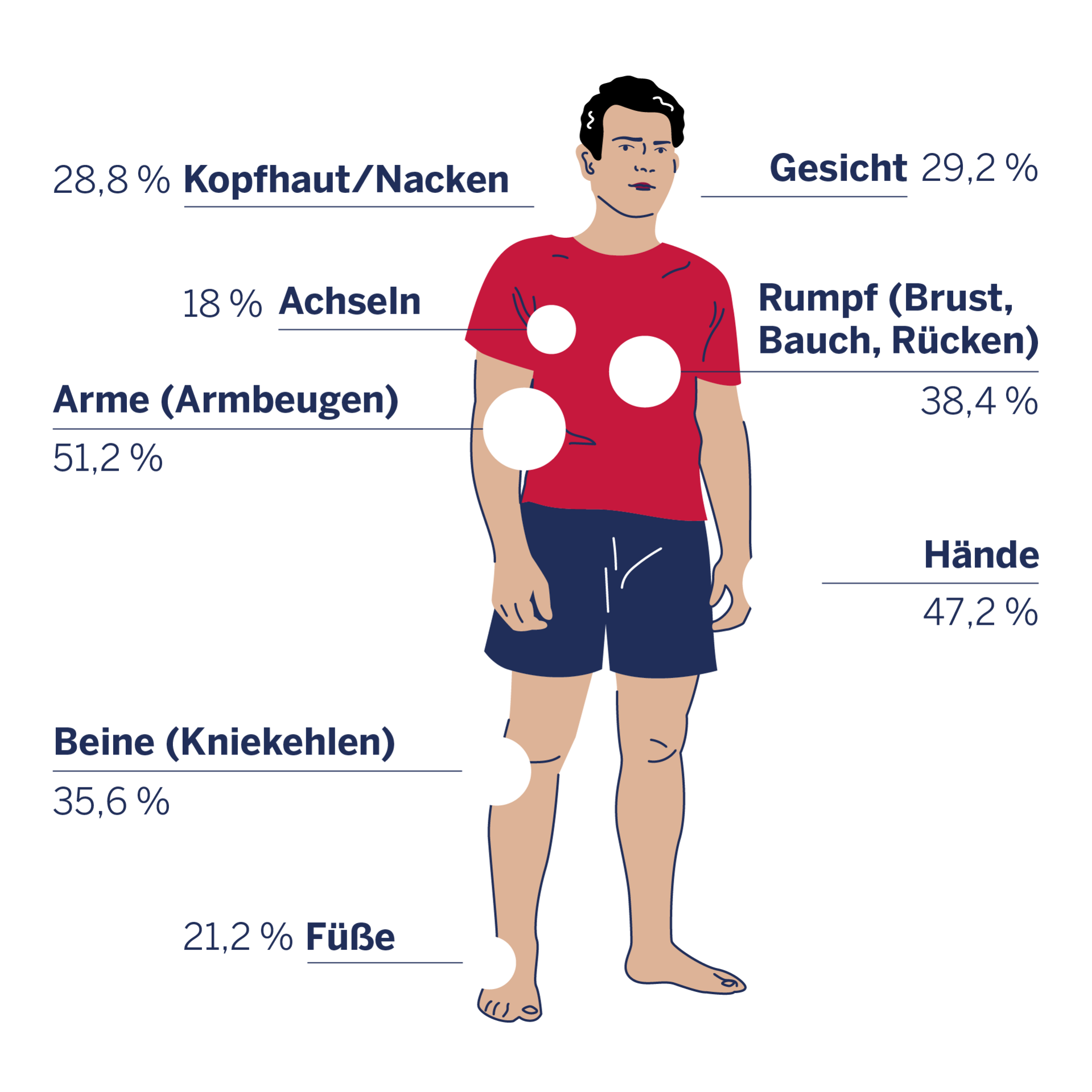 Infografik zu den von Neurodermitis betroffenen Körperstellen bei Männern.