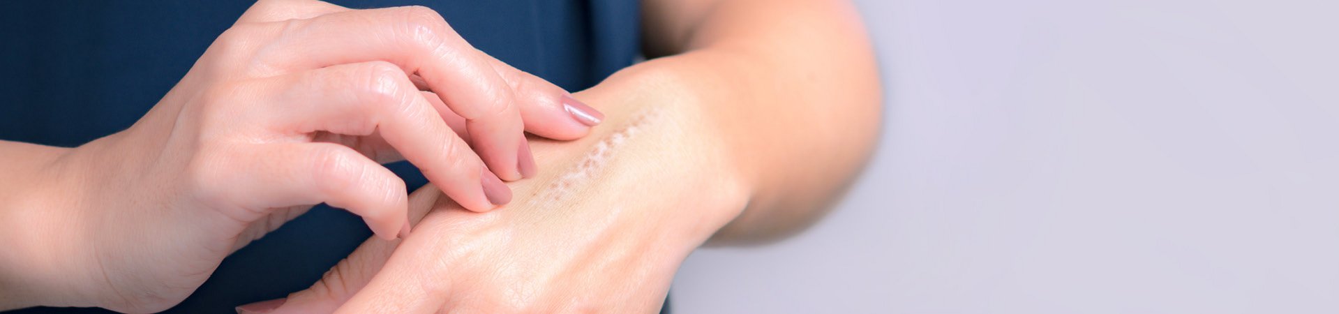 Narbe auf dem Handrücken