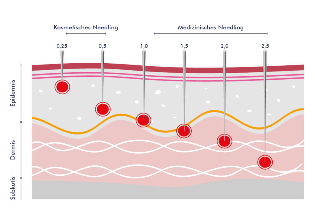 Grafische Darstellung der Nadeltiefe beim Needling