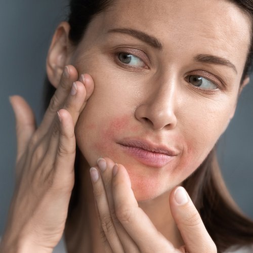 Frau mit Perioraler Dermatitis