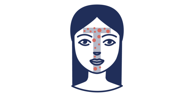 Illustration der Acne vulgaris in der T-Zone